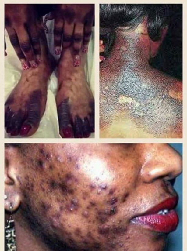 Le "xessal", cette pratique qui tue à petit feu Le "xessal", cette pratique qui tue à petit feu