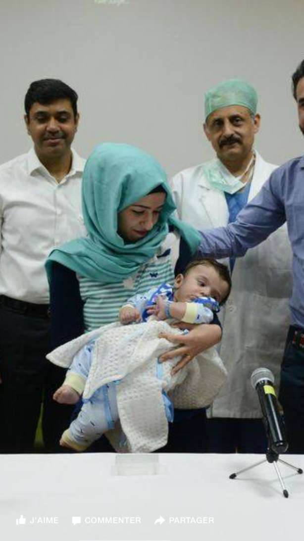 Un bébé né avec huit bras et jambes opérés avec succès Un bébé né avec huit bras et jambes opérés avec succès