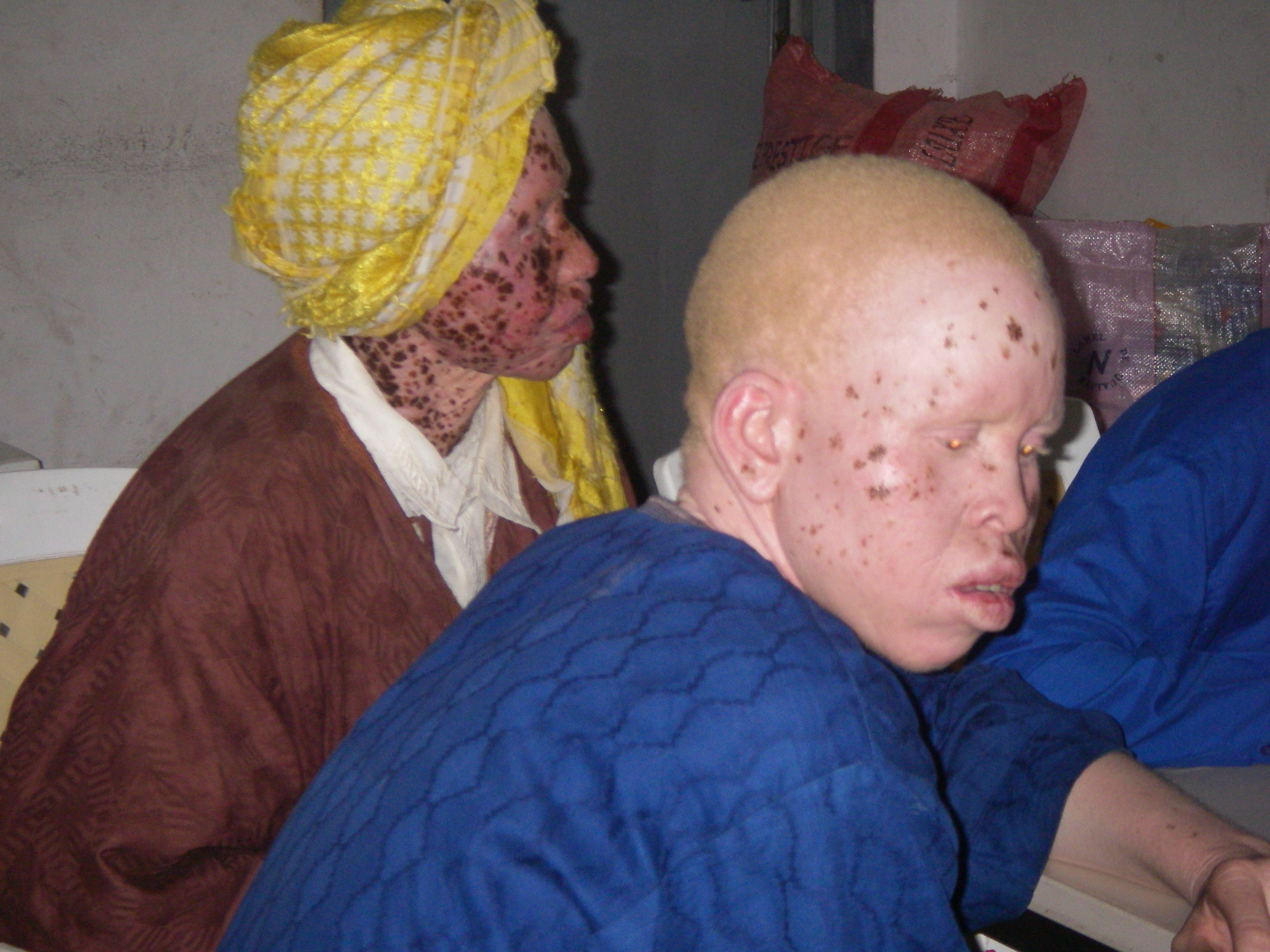 Elections législatives : L'inquiétude des albinos 