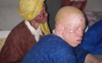 Elections législatives : L'inquiétude des albinos 